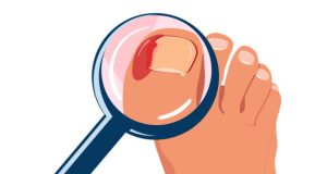 Diagnosis of Ingrown Toenail