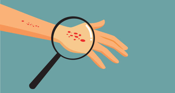 Cartoon magnifying glass examining insect bites on a hand