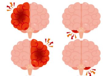 Illustration of four brains showing areas of inflammation, used to depict diagnosis of Japanese encephalitis