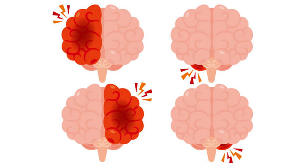 Illustration of four brains showing areas of inflammation, used to depict diagnosis of Japanese encephalitis