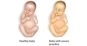 Illustration comparing a healthy baby to a baby with severe jaundice, showing yellow skin discolouration