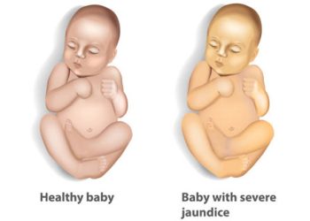 Illustration comparing a healthy baby to a baby with severe jaundice, showing yellow skin discolouration
