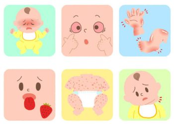 Cartoon showing visual signs used in diagnosing Kawasaki Disease in infants