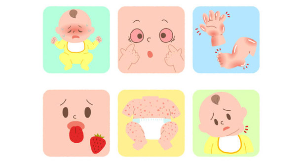 Cartoon showing visual signs used in diagnosing Kawasaki Disease in infants