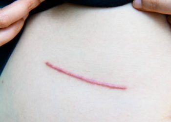 Doctor examining a red, raised scar suspected to be a keloid on the lower abdomen