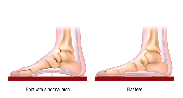 Medical illustration comparing flat feet and a normal foot arch