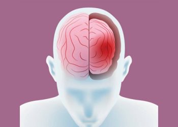 Medical illustration of frontotemporal dementia affecting the brain