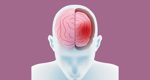 Medical illustration of frontotemporal dementia affecting the brain