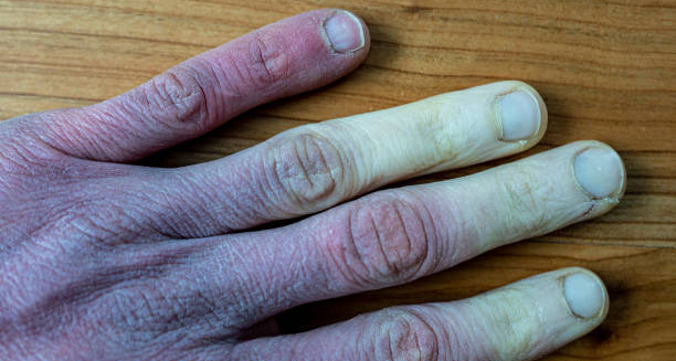 Hand with discoloured fingers showing signs of frostbite damage