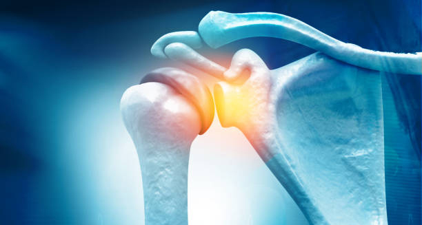 3D illustration of a frozen shoulder joint with inflammation