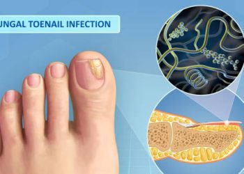 Illustration of fungal toenail infection with close-up view of fungus