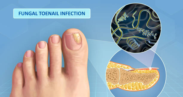 Illustration of fungal toenail infection with close-up view of fungus