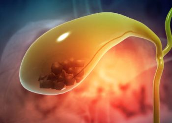 Medical illustration of gallstones inside the gallbladder