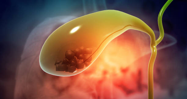 Medical illustration of gallstones inside the gallbladder