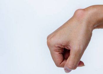 Ganglion cyst on the wrist of a human hand