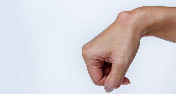 Ganglion cyst on the wrist of a human hand
