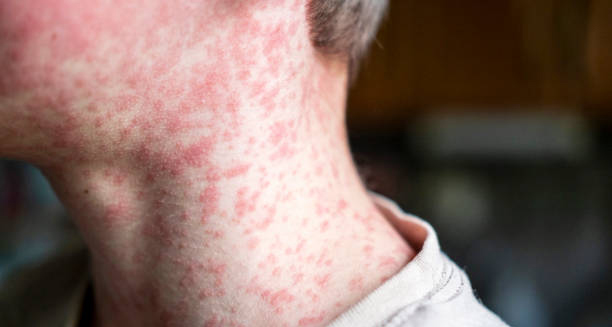 Red rash on the neck and jawline of a person with German Measles