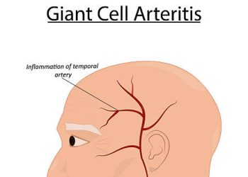 Medical illustration showing inflammation of the temporal artery in Giant Cell Arteritis