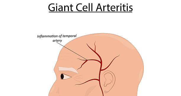 Medical illustration showing inflammation of the temporal artery in Giant Cell Arteritis