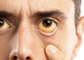 Close-up of a man's yellowish eyes – Gilbert’s Syndrome