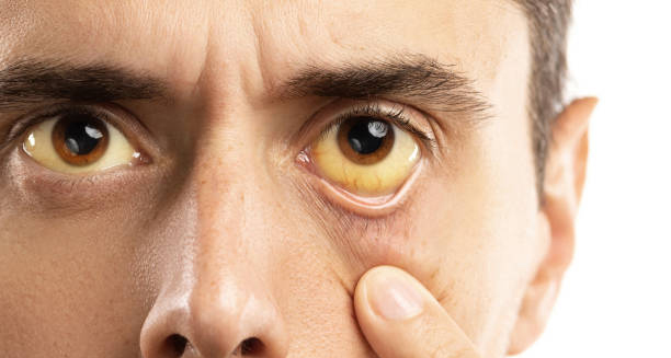 Close-up of a man's yellowish eyes – Gilbert’s Syndrome