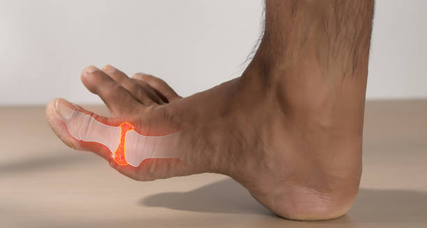 Inflamed toe joint with highlighted gout pain