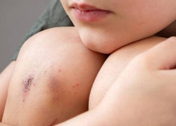 Close-up of a child's grazed knee with minor cuts and bruises
