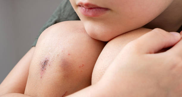 Close-up of a child's grazed knee with minor cuts and bruises