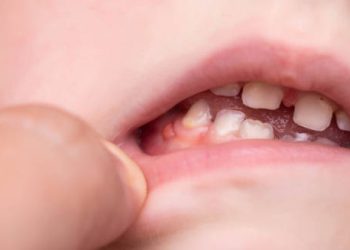 Close-up of inflamed gums in a child’s mouth