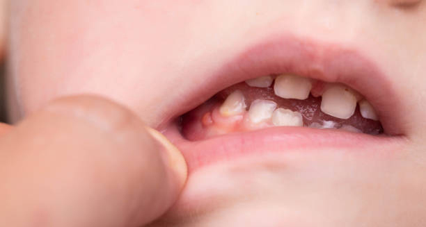 Close-up of inflamed gums in a child’s mouth