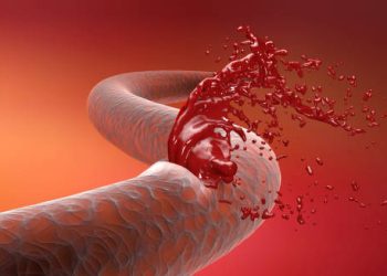 Damaged blood vessel leaking blood, symbolising haemophilia