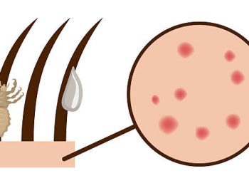 Diagram showing head lice, eggs on hair shafts, and red scalp irritation under magnification