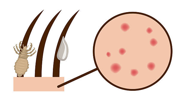 Diagram showing head lice, eggs on hair shafts, and red scalp irritation under magnification