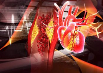 Digital illustration of a human heart and artery showing disrupted blood flow and arrhythmia