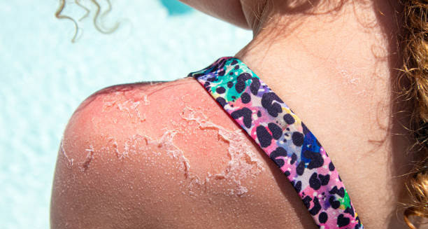 Peeling sunburned skin on shoulder caused by heat rash