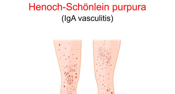 Illustration of Henoch-Schönlein Purpura (IgA vasculitis) with red spots on lower legs