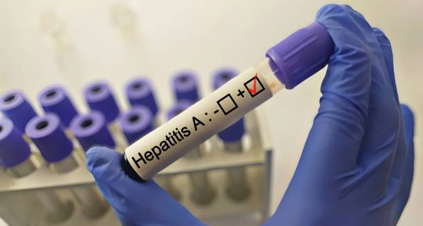 Positive Hepatitis A test sample held by a gloved hand in a laboratory