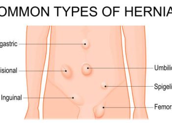 Diagram showing common types of hernias on the abdominal wall