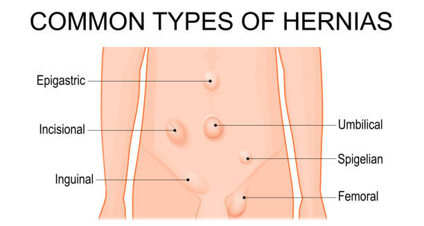 Diagram showing common types of hernias on the abdominal wall