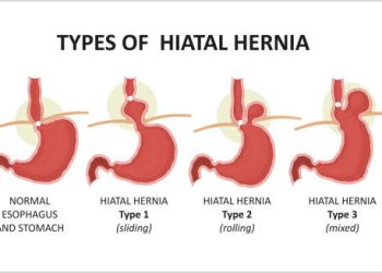 Medical illustration showing types of hiatal hernia including sliding, rolling, and mixed