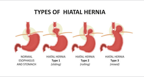 Medical illustration showing types of hiatal hernia including sliding, rolling, and mixed