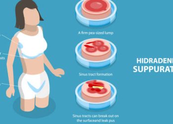 Medical diagram showing hidradenitis suppurativa stages and affected body areas in a woman