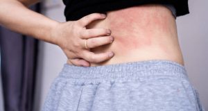 Close-up of irritated skin with red hives on a person's lower back