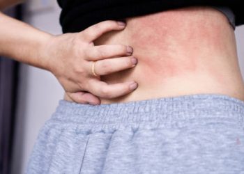 Close-up of irritated skin with red hives on a person's lower back
