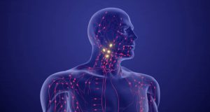 Hodgkin Lymphoma