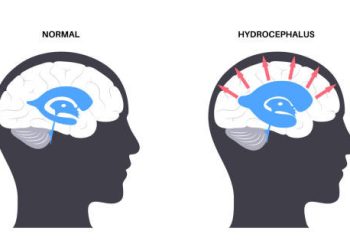 Comparison of normal brain and hydrocephalus showing fluid buildup and pressure