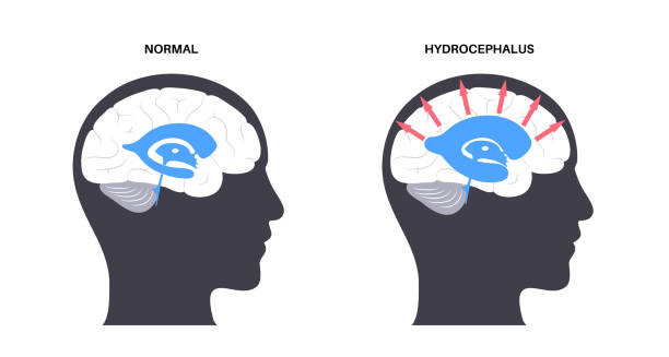 Comparison of normal brain and hydrocephalus showing fluid buildup and pressure