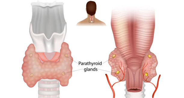 Medical illustration of parathyroid glands affected by hyperparathyroidism