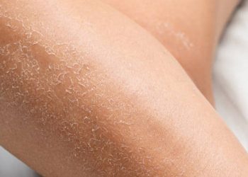 Close-up of leg showing dry, scaly skin caused by ichthyosis