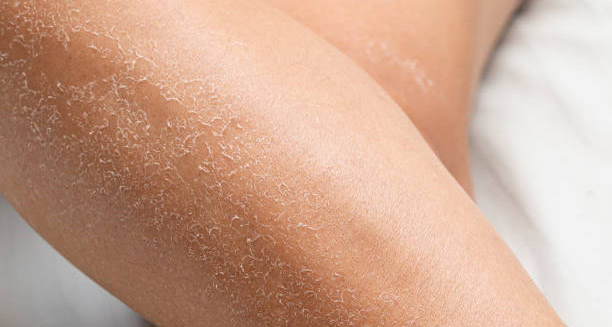 Close-up of leg showing dry, scaly skin caused by ichthyosis